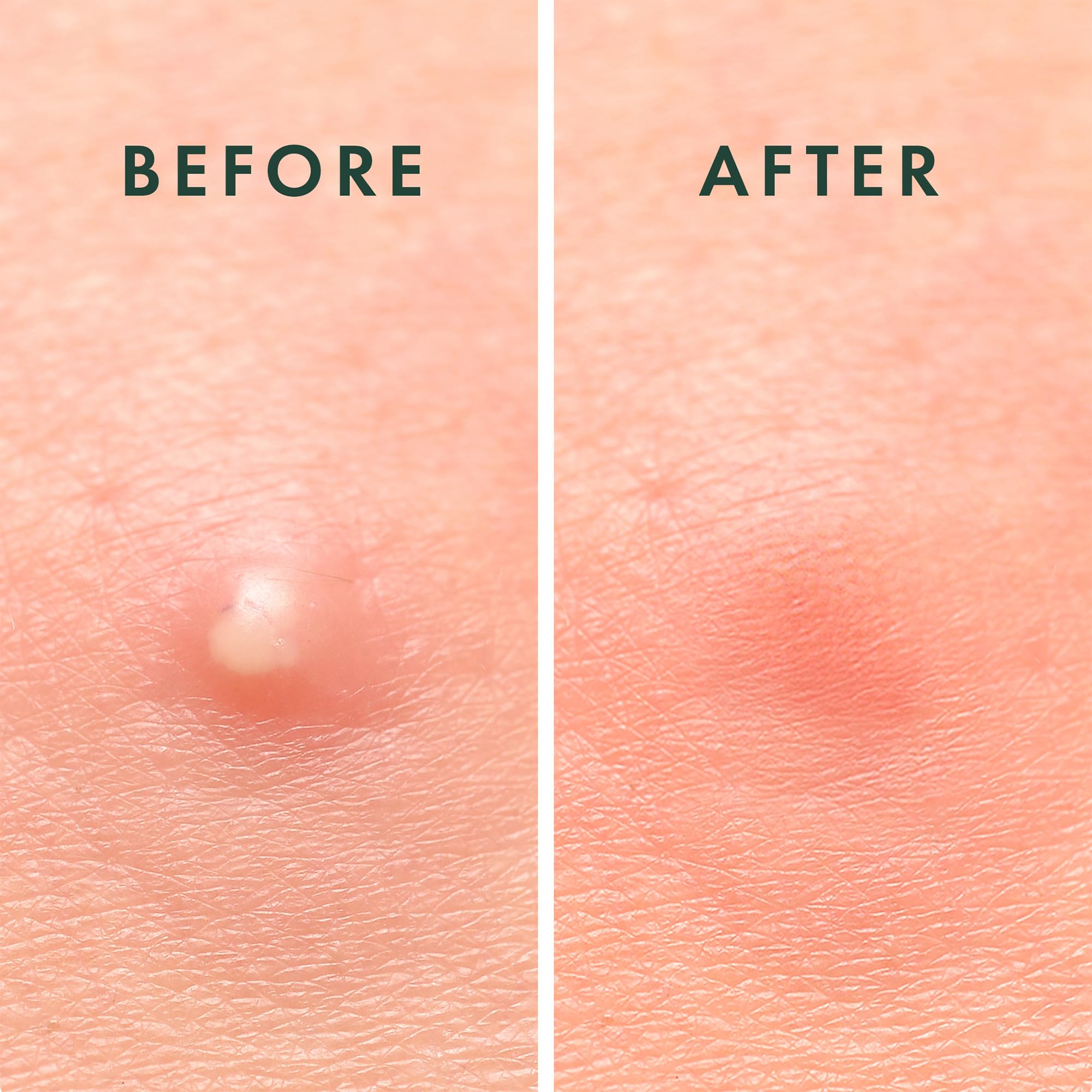 Rael Pimple Patches, Miracle Invisible Spot Cover - Hydrocolloid Acne Pimple Patch