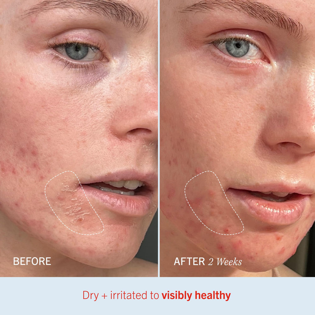 First Aid Beauty - Ultra Repair Cream, Intense Hydration Whipped Colloidal Oatmeal, Clinically Proven to Strengthen Skin Barrier in 7 Days