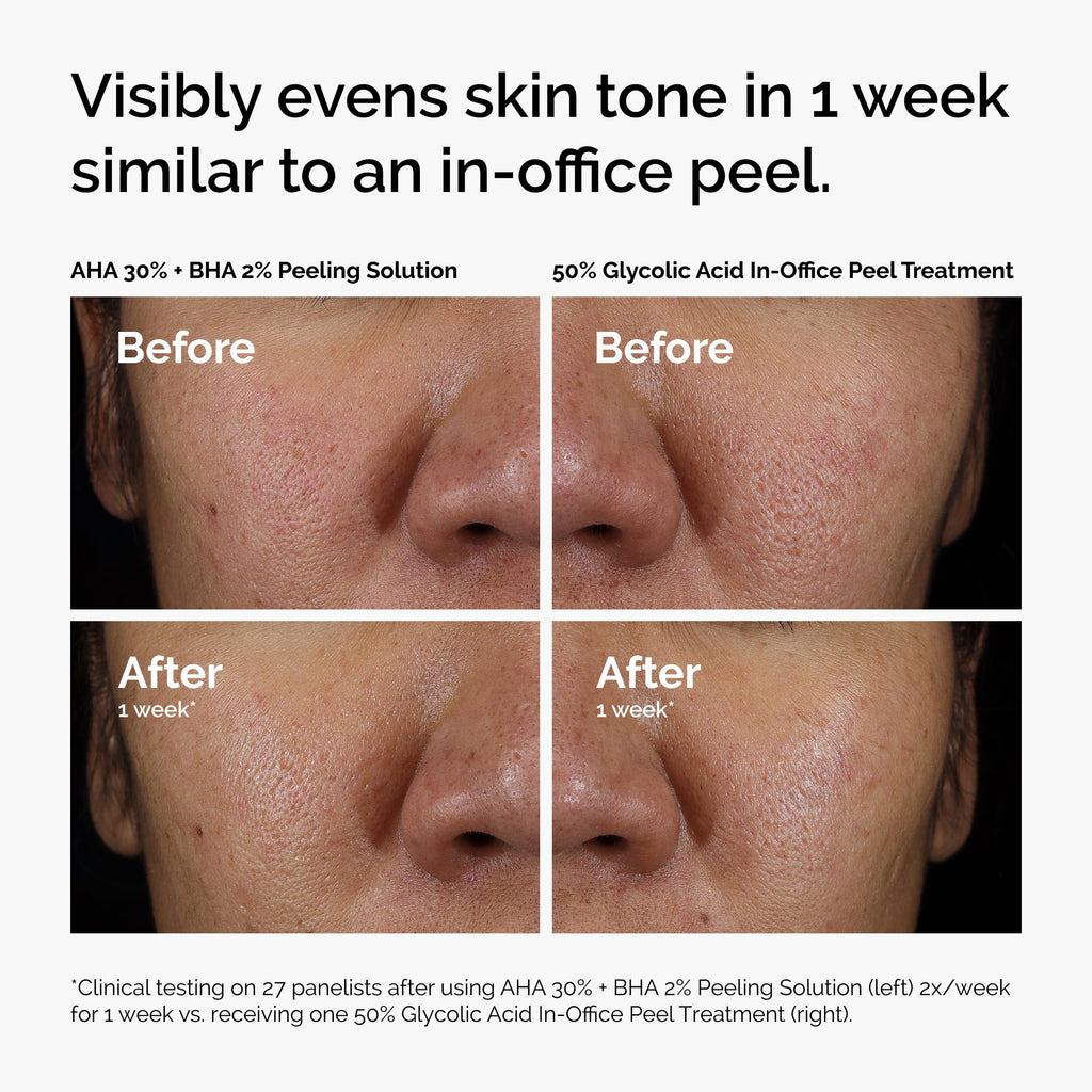 The Ordinary AHA 30% + BHA 2% Peeling Solution, Advanced Exfoliating Peel for Brighter Skin, 1 Fl Oz