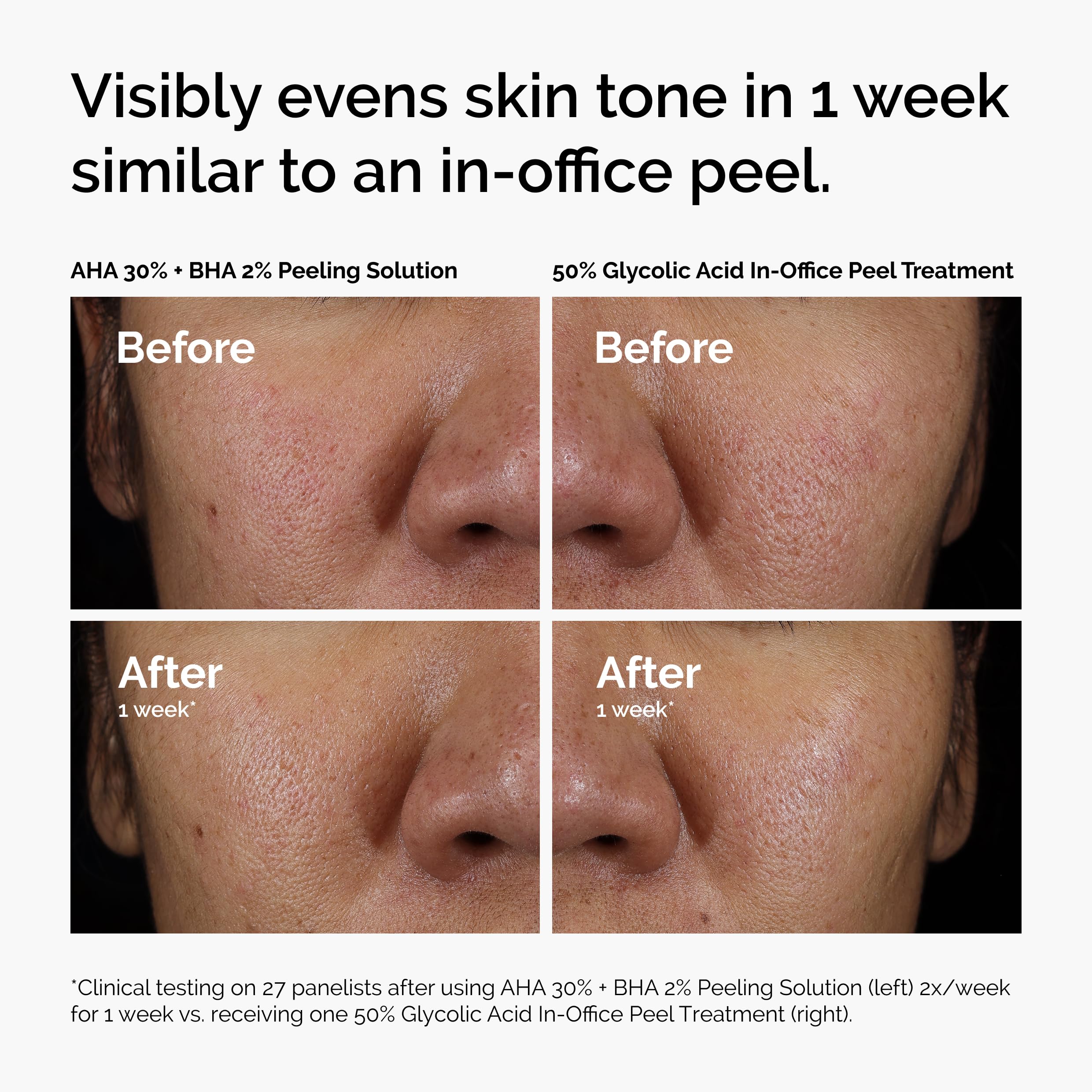 The Ordinary AHA 30% + BHA 2% Peeling Solution, Advanced Exfoliating Peel for Brighter Skin, 1 Fl Oz