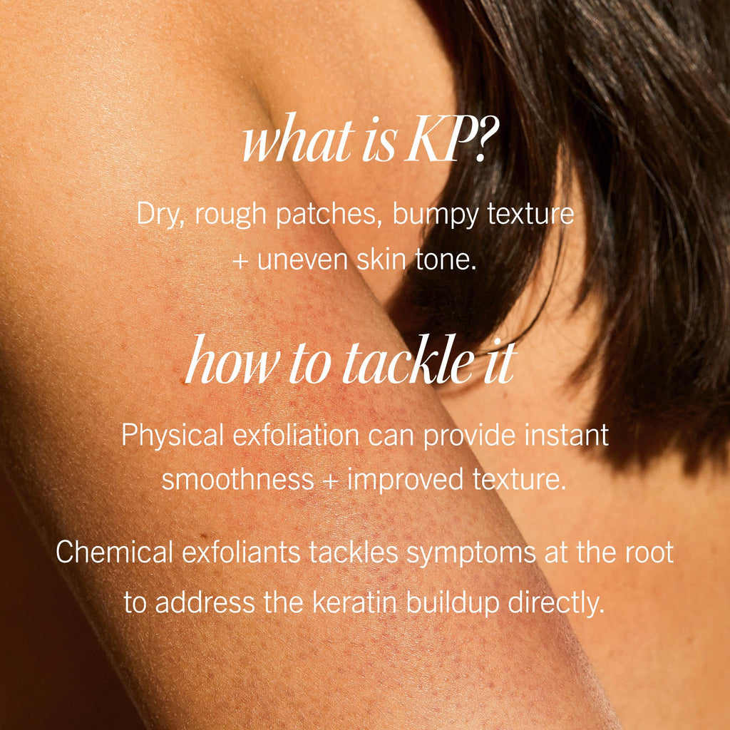First Aid Beauty - KP Bump Eraser Body Scrub with 10% AHA, Keratosis Pilaris Exfoliator with Glycolic and Lactic acids, Helps Reduce Chicken Skin Bumps