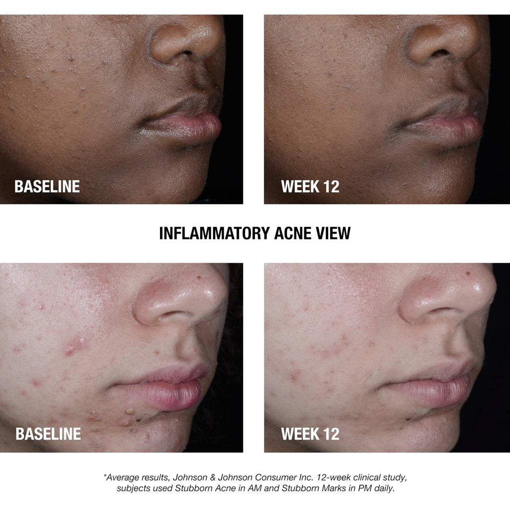 Neutrogena Stubborn Acne AM Face Treatment with 2.5% Micronized Benzoyl Peroxide Acne Medication, Oil-Free Daily Facial Treatment Reduces Size