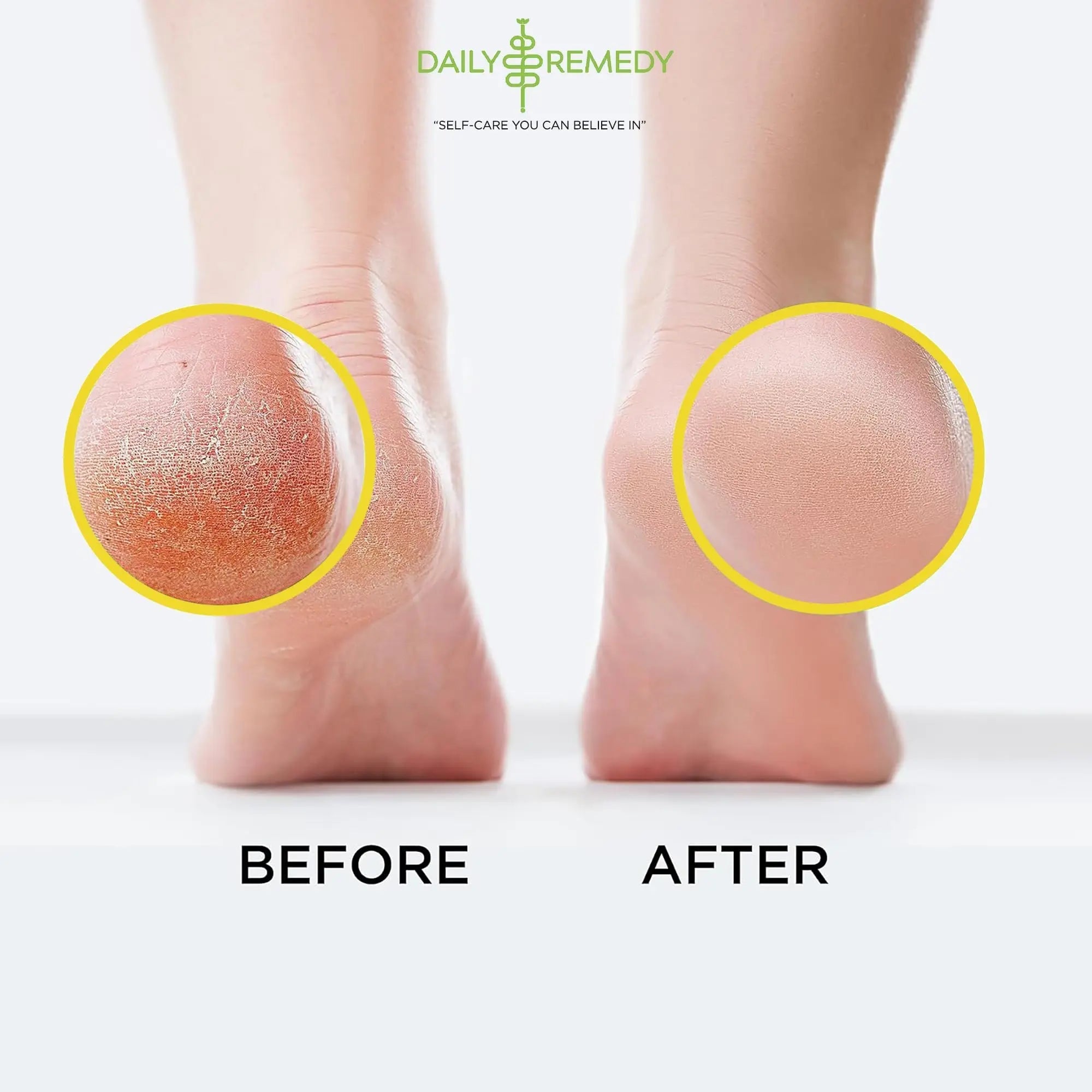 Citrus Detox Foot Soak with Epsom Salt - for Foot Callus, Immune Boost, Damaged Toenail - TrustMedUSA