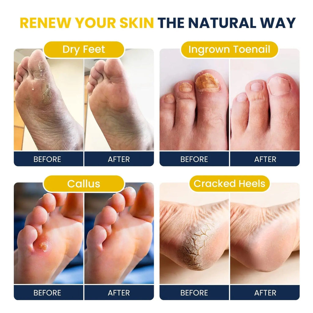 Citrus Detox Foot Soak With Epsom Salts - for Foot Callus, Immune Boost, Damaged Toenail - TrustMedUSA