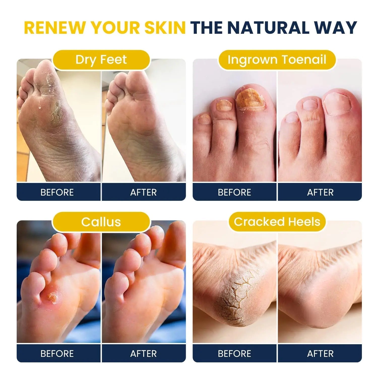 Citrus Detox Foot Soak With Epsom Salts - for Foot Callus, Immune Boost, Damaged Toenail - TrustMedUSA