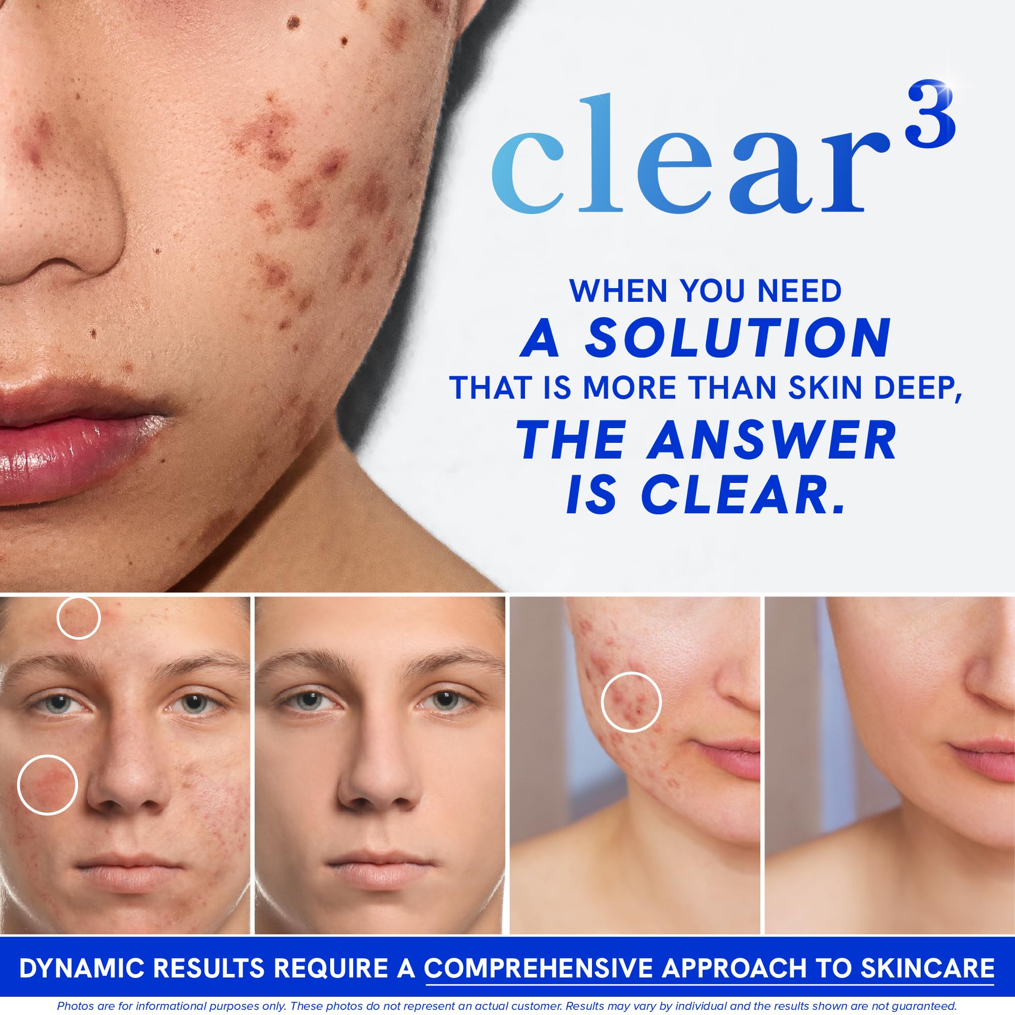 Clear Skin Supplement with Zinc, DIM & Probiotics | 3-in-1 Balance, Glow & Health Skin Support | Triple Action Hyaluronic Acid, Niaciminide & Vitamins for Hormone, Complexion & Gut Support | 180 Ct - TrustMedUSA