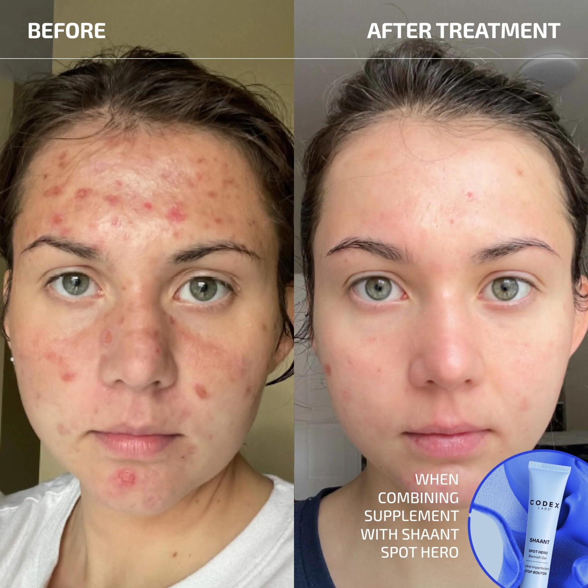 Codex Labs Shaant Clear Skin Supplement – 60 Vegan Capsules | Acne Probiotics with 9-Strain Blend, Green Tea EGCG & Guggul – Daily Support for Acne-Prone Skin & Clear Complexion - TrustMedUSA