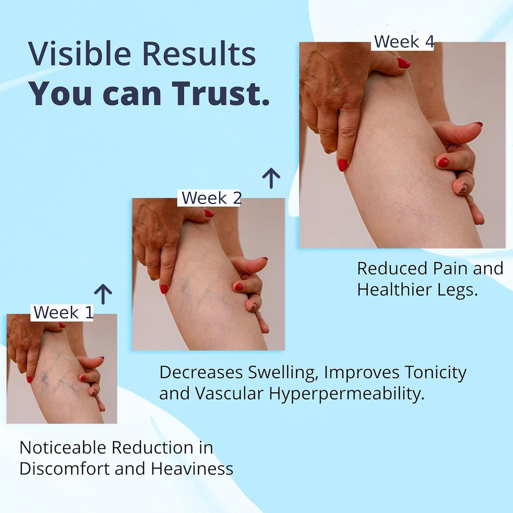 Cream Ayurvedic Solution for Management of Varicose Veins, Spider Veins, Varicocele Helps Reach The Root Cause of varicose Veins Reduces Cramps, Itching & Swelling. Single Tube (25 GMS). - TrustMedUSA