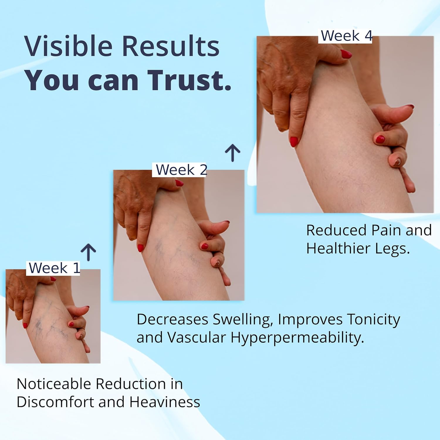 Cream Ayurvedic Solution for Management of Varicose Veins, Spider Veins, Varicocele Helps Reach The Root Cause of varicose Veins Reduces Cramps, Itching & Swelling. Single Tube (25 GMS). - TrustMedUSA