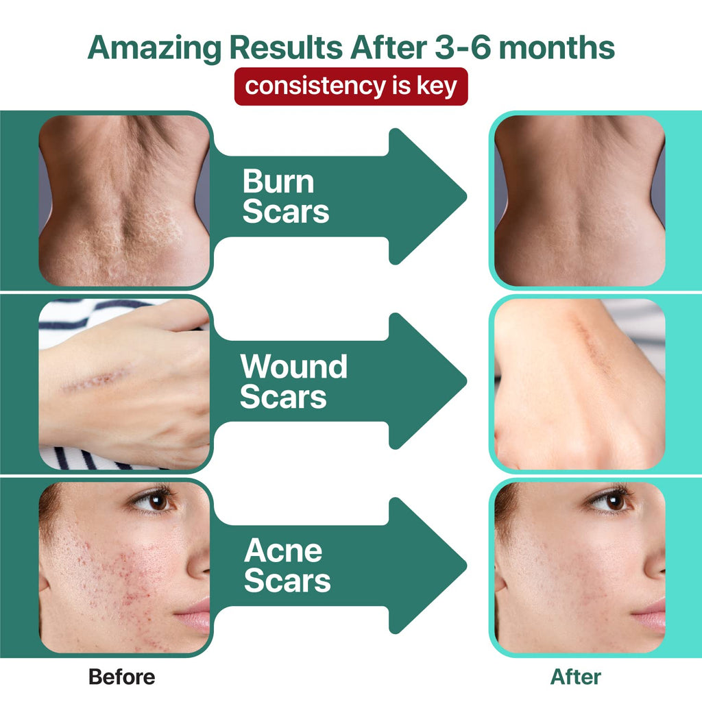 Ebanel Bundle of 30% AHA 2% BHA Chemical Peel and Advanced Silicone Scar Gel - Maple Wellness Supplements