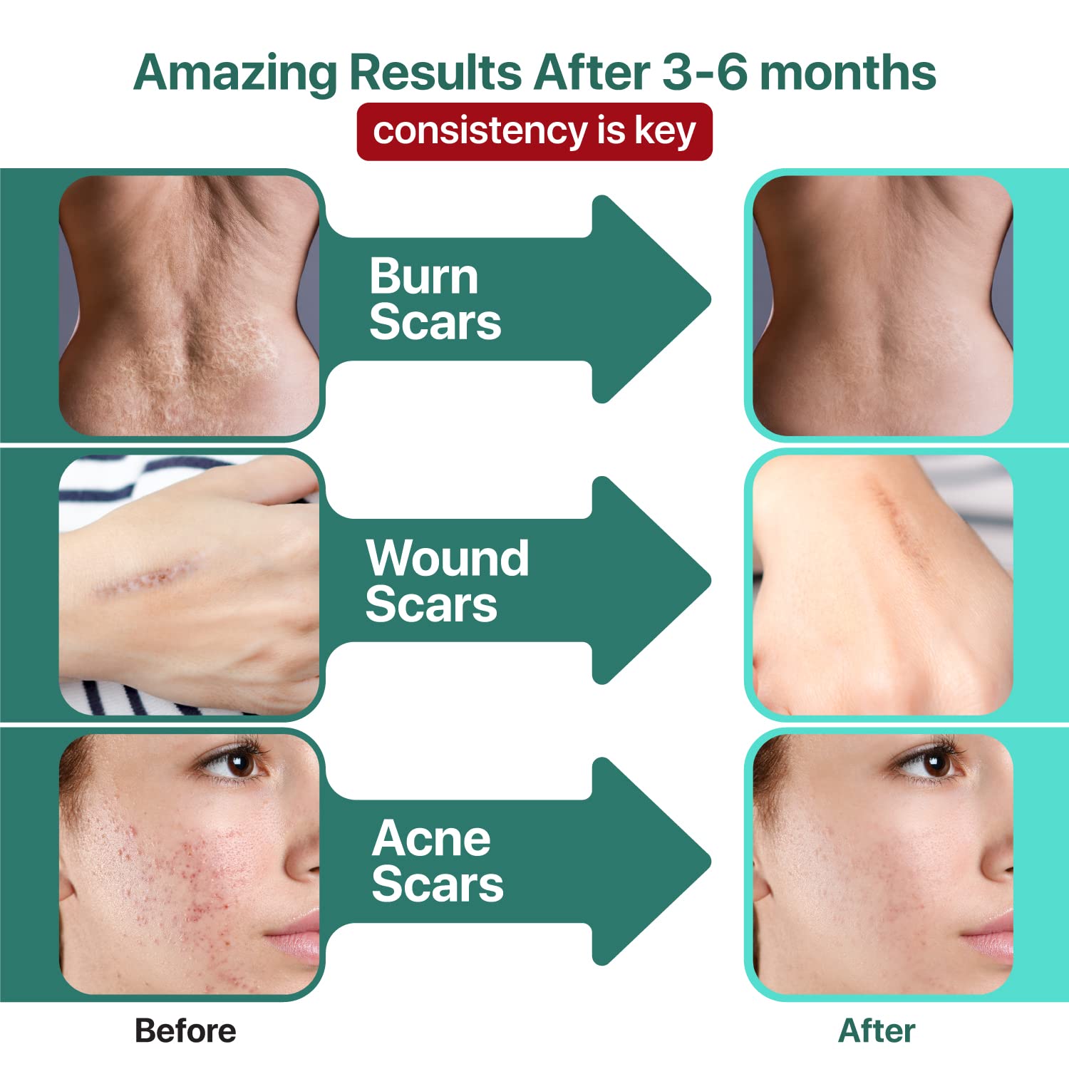 Ebanel Bundle of Advanced Silicone Scar Gel 1 Oz, and Hyaluronic Acid Serum - Maple Wellness Supplements