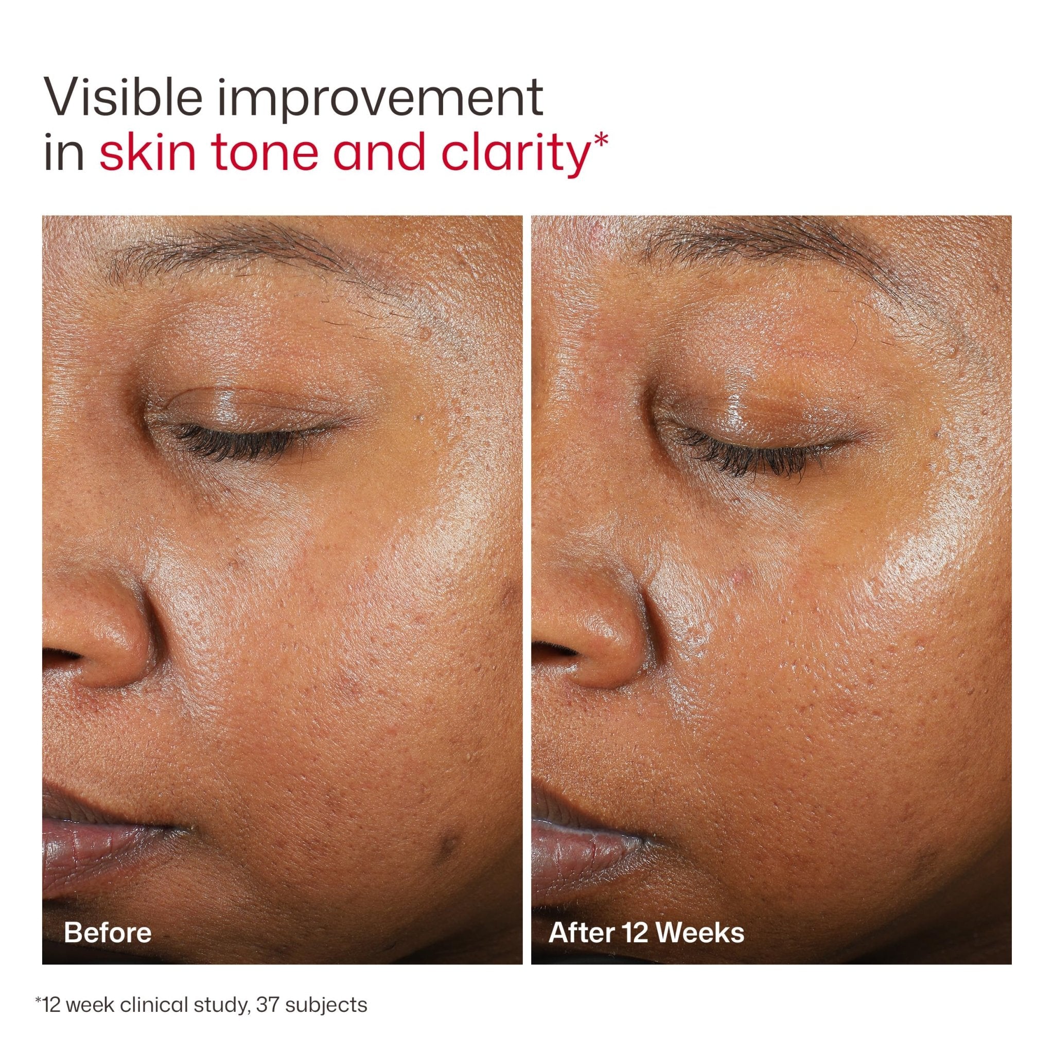 EltaMD UV Clear Tinted Sunscreen for Face, SPF 46 with Zinc Oxide, Oil-Free, Dermatologist Recommended, For Acne-Prone Sensitive Skin, 1.7 oz - TrustMedUSA
