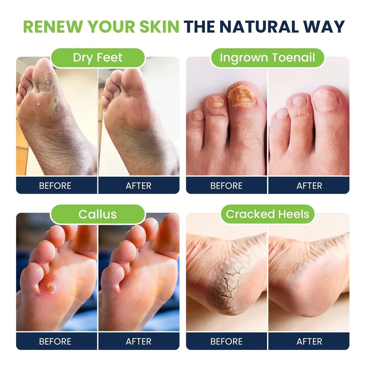 Foot Soak with Epsom Salts- Variety Pack of 4- Tea Tree Oil, Muscle Relief, Calming - TrustMedUSA