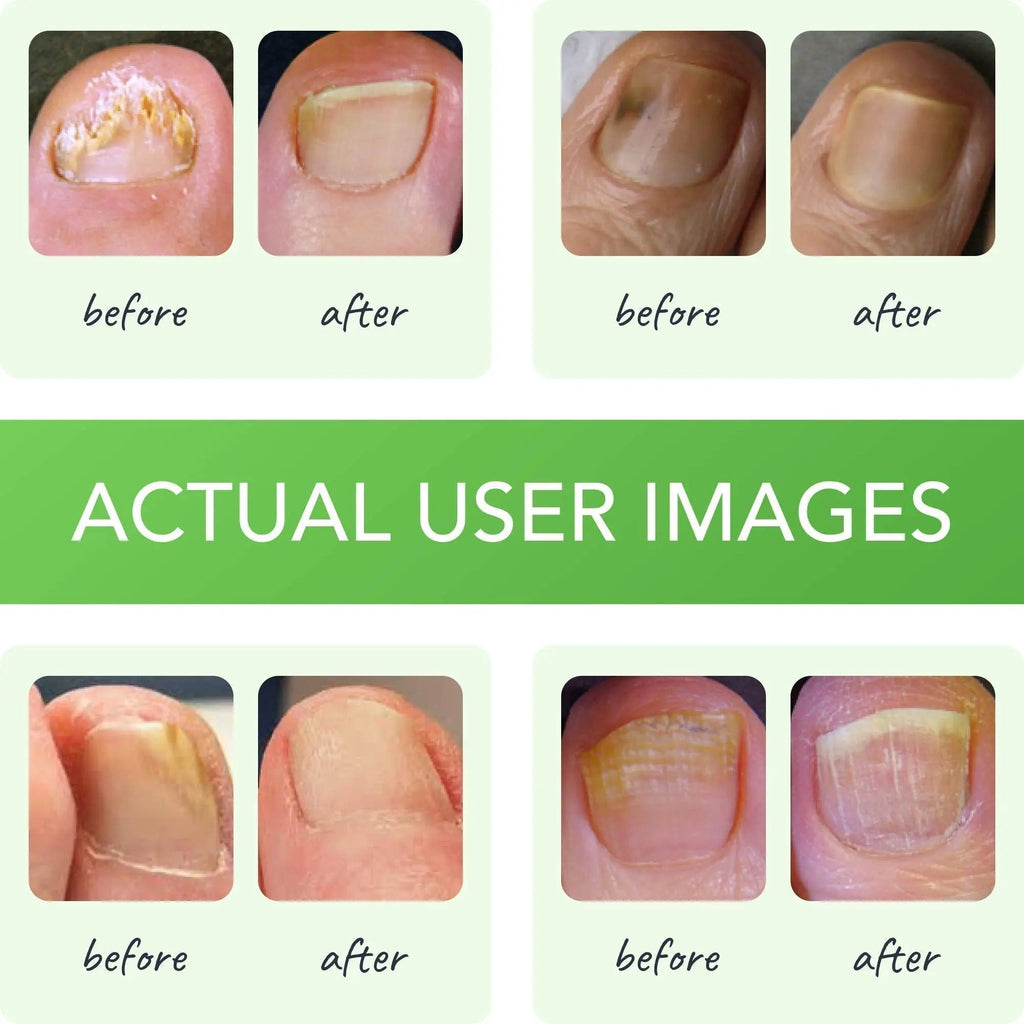 FUNGINIX Healthy Nail Formula - Finger And Toe Fungus Treatment, Made In USA, Foot - TrustMedUSA