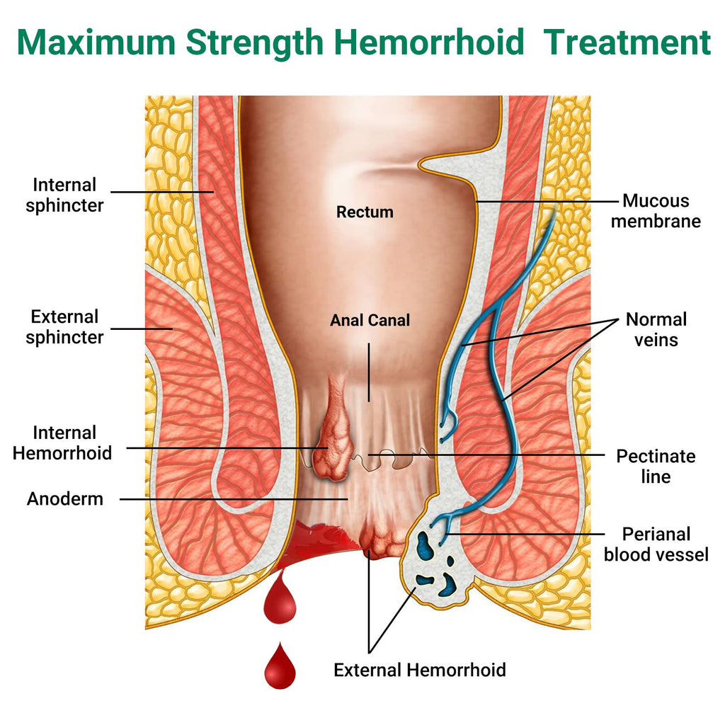 Hemorrhoid Treatment Ointment, Maximum Strength Treatment & Fast Relief for Pain, Itching, Burning, Swelling, Fissure, Bleeding, Discomfort, Long-Lasting Internal & External Hemorrhoid Cream, (2-Pack) - TrustMedUSA