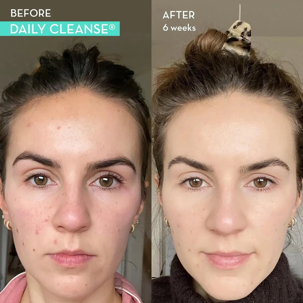 HUM Daily Cleanse Acne Supplements - Support for Clear Skin & Improved Digestion - TrustMedUSA