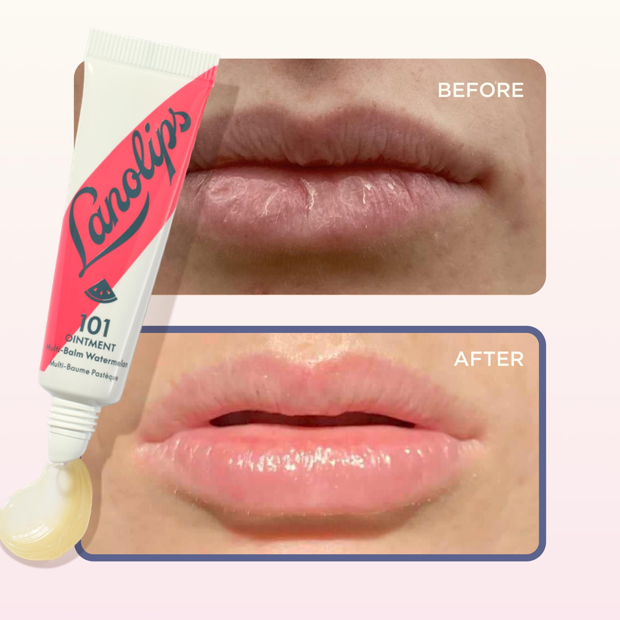 Lanolin 101 Multipurpose Ointment - Lanolin Lip Balm & Healing Ointment for Skin Barrier Repair - Moisturizer for Dry Lips, Cuticles & Elbows - No Petroleum Formula - Watermelon (0.35 oz) - TrustMedUSA