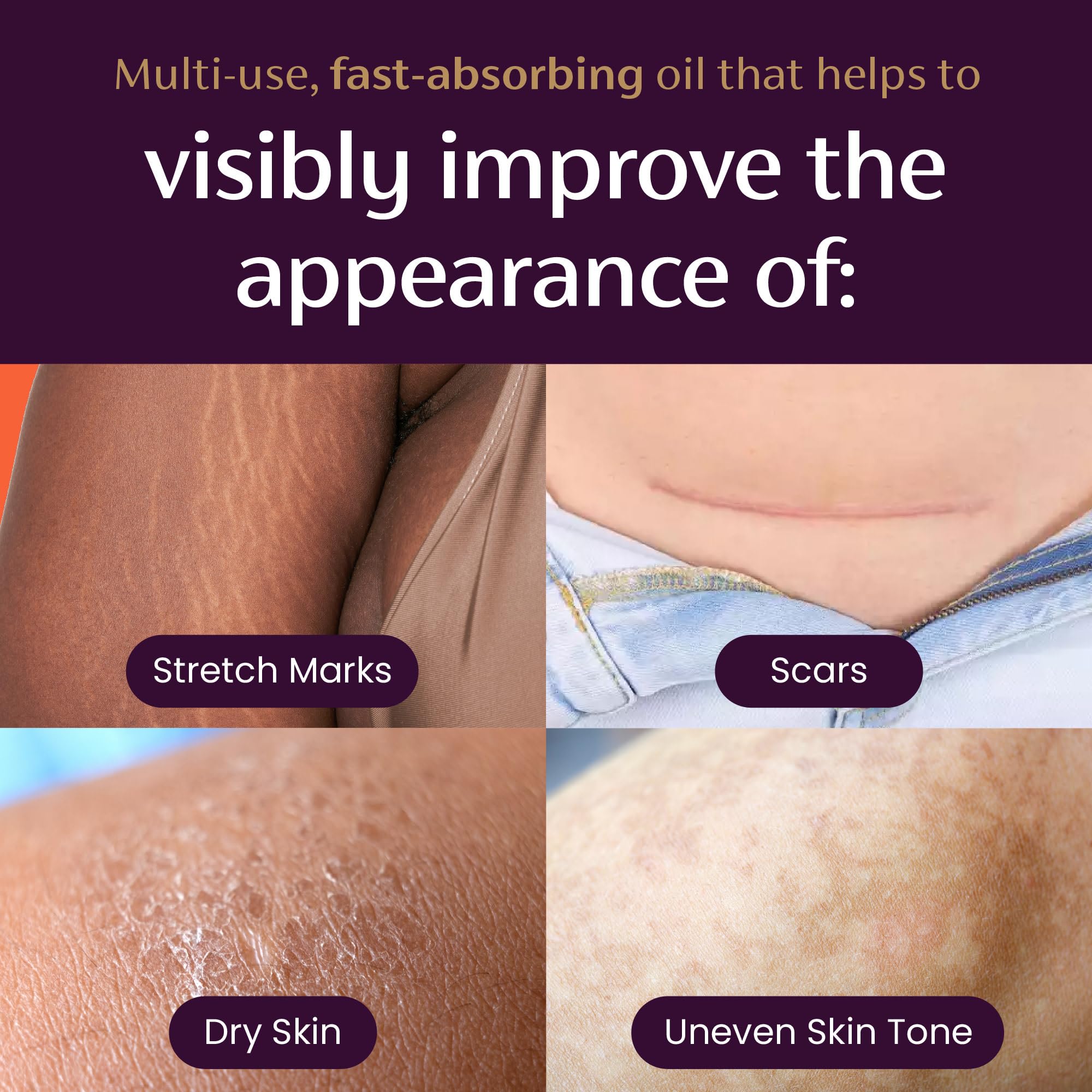 Mederma Quick Dry Oil, Scar and Stretch Mark Treatment, Helps to Improve the Appearance with Natural Botanical Extracts, Paraben Free, Fast-Absorbing, 3.4oz (100ml) - TrustMedUSA