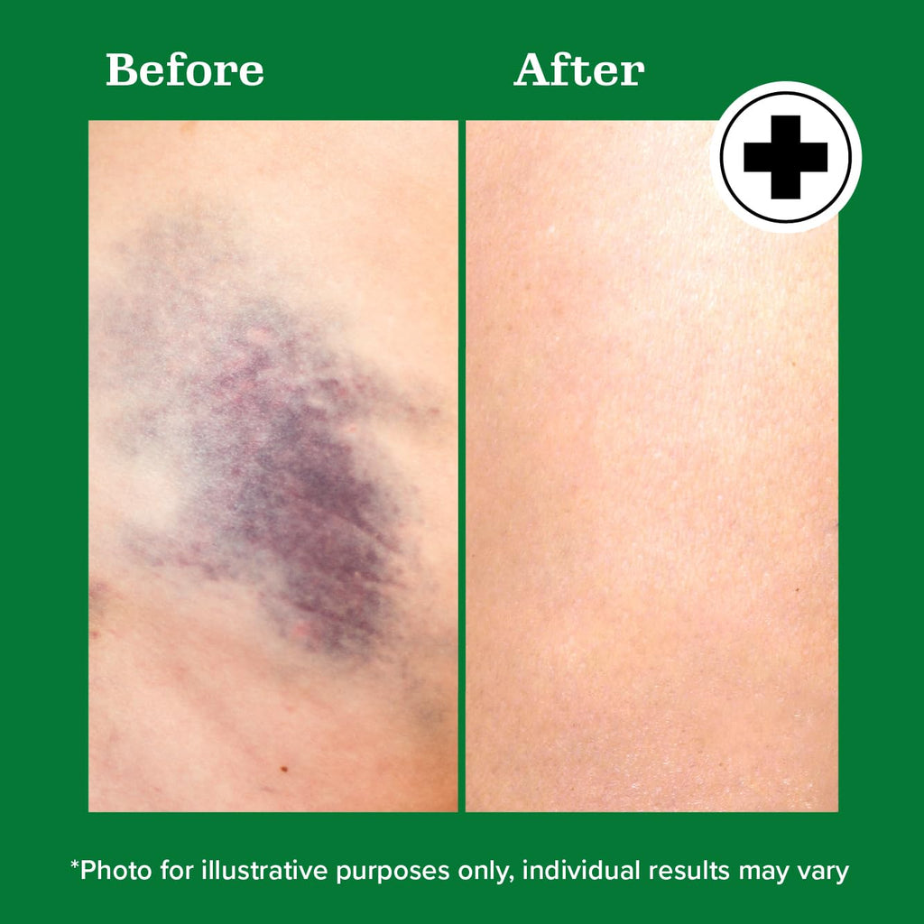 Miracle Plus Arnica Bruise Relief Gel + Magnesium Leg Relief Cream Bundle - TrustMedUSA