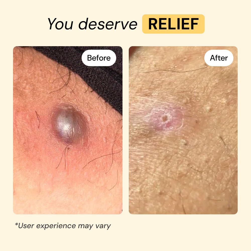 MyMagicHealer Universal Flare Care – Multi-Purpose Solution | Skin Flare-Ups - Hidradenitis Suppurativa, Folliculitis, Boils, Cysts - TrustMedUSA