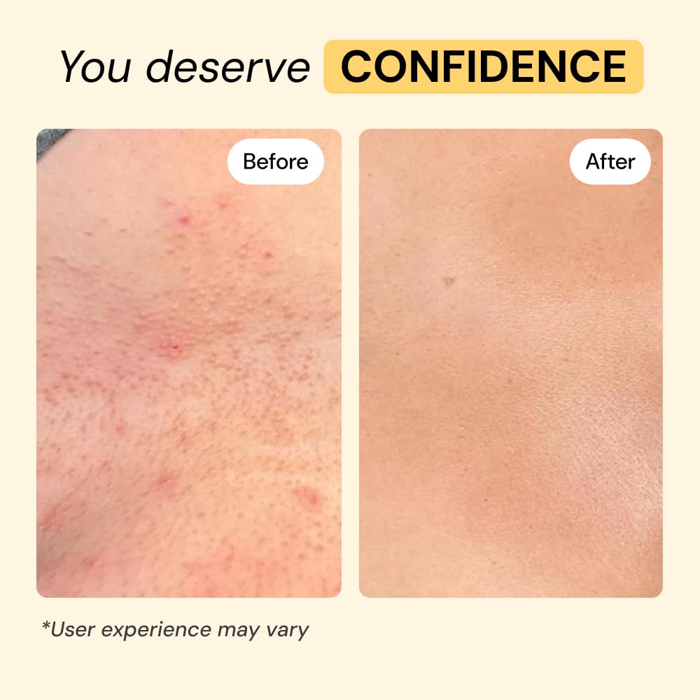 MyMagicHealer Universal Flare Care – Multi-Purpose Solution | Skin Flare-Ups - Hidradenitis Suppurativa, Folliculitis, Boils, Cysts - TrustMedUSA