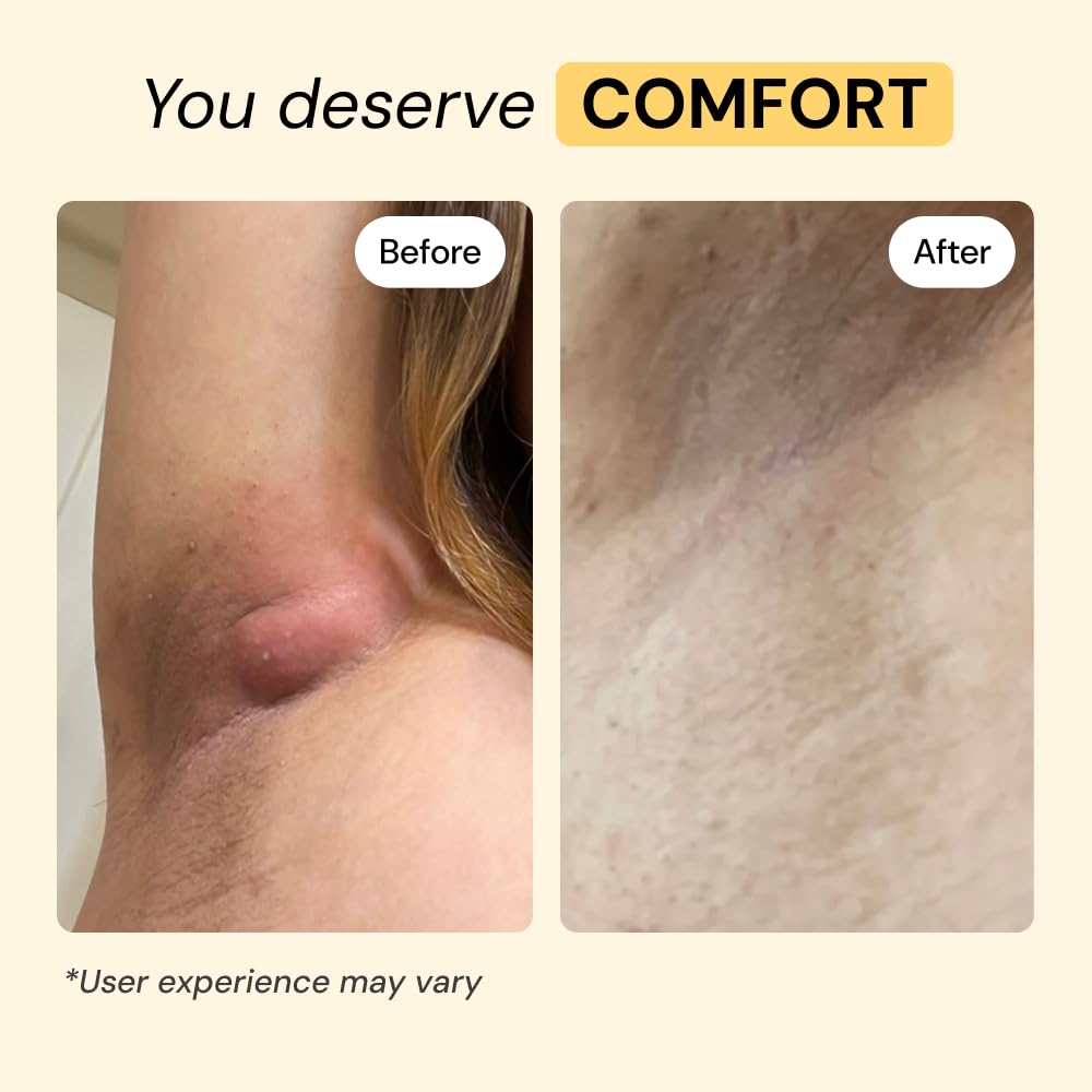MyMagicHealer Universal Flare Care – Multi-Purpose Solution | Skin Flare-Ups - Hidradenitis Suppurativa, Folliculitis, Boils, Cysts - TrustMedUSA