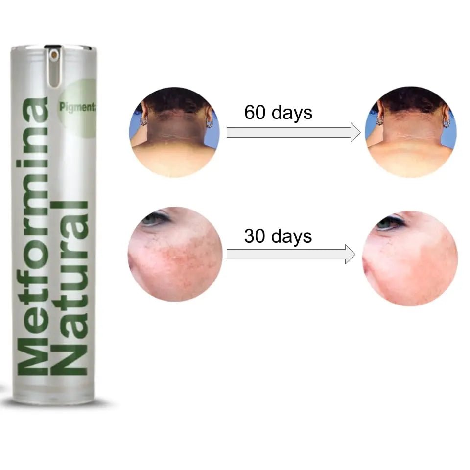 Ni una dieta más METFORMINA NATURAL - Cream for Dark Spots on Face and Body - TrustMedUSA