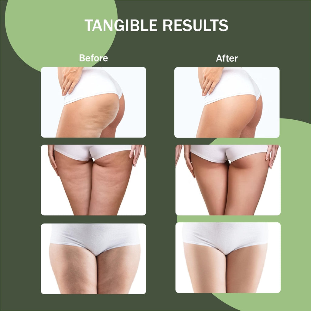 Osmibe Cellulite Manual Massager - Lymphatic Drainage Massager with Detachable Handles - Reduce Cellulite and Stretch Marks on Legs and Body - Maple Wellness Supplements