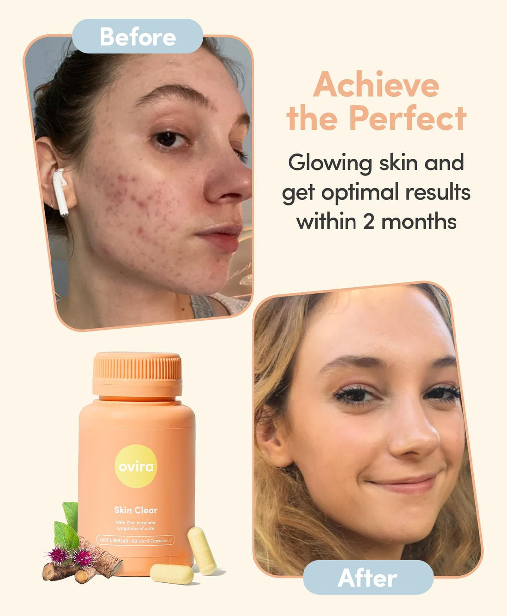 Ovira Skin Clear with ZINCBRIGHT - 60 Capsules for Clear and Glowing Skin | Rosacea & Hormonal Acne Treatment | Support Collagen Production | Acne Supplements for Women & Men - Pack of 2 - TrustMedUSA