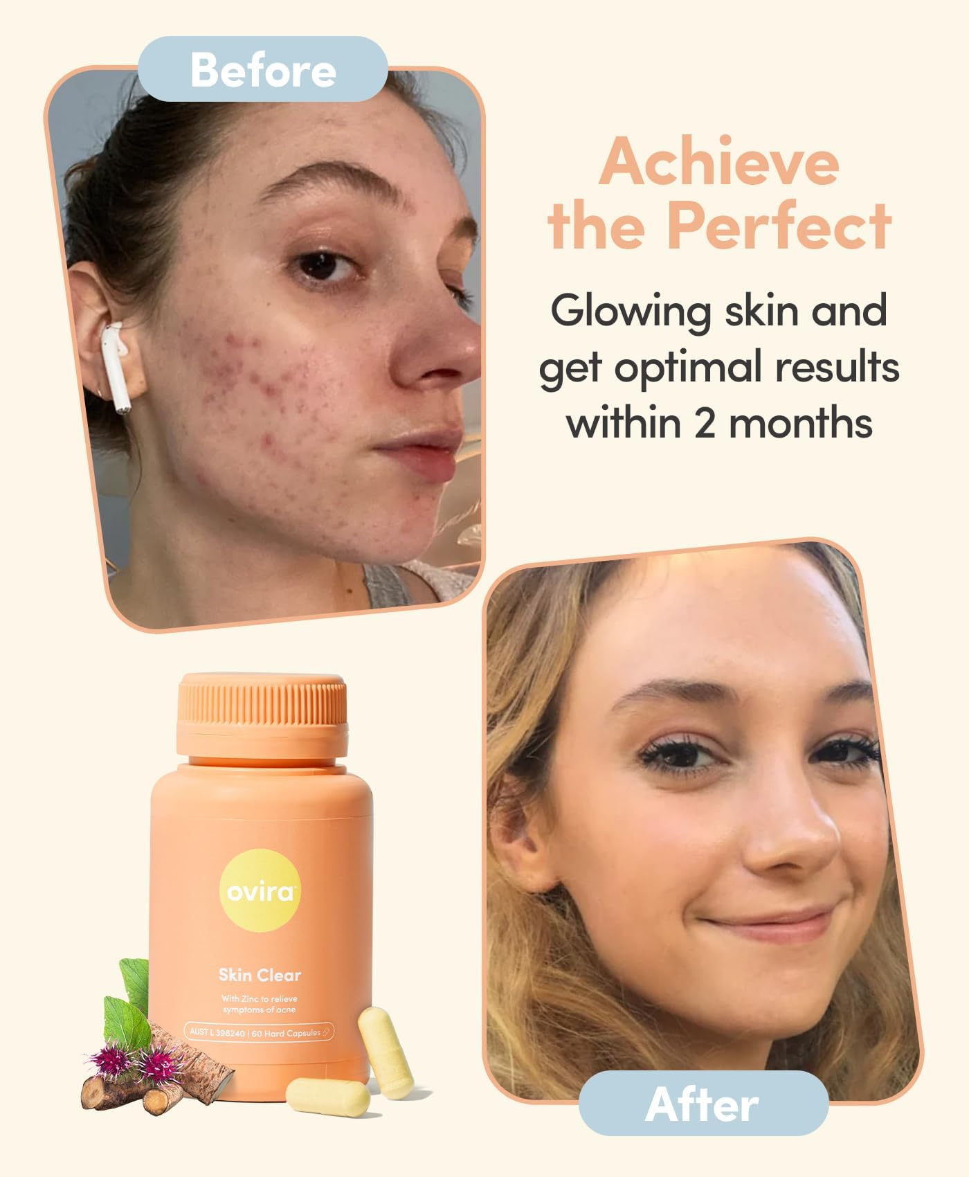 Ovira Skin Clear with ZINCBRIGHT - 60 Capsules for Clear and Glowing Skin | Rosacea & Hormonal Acne Treatment | Support Collagen Production | Acne Supplements for Women & Men - Pack of 2 - TrustMedUSA
