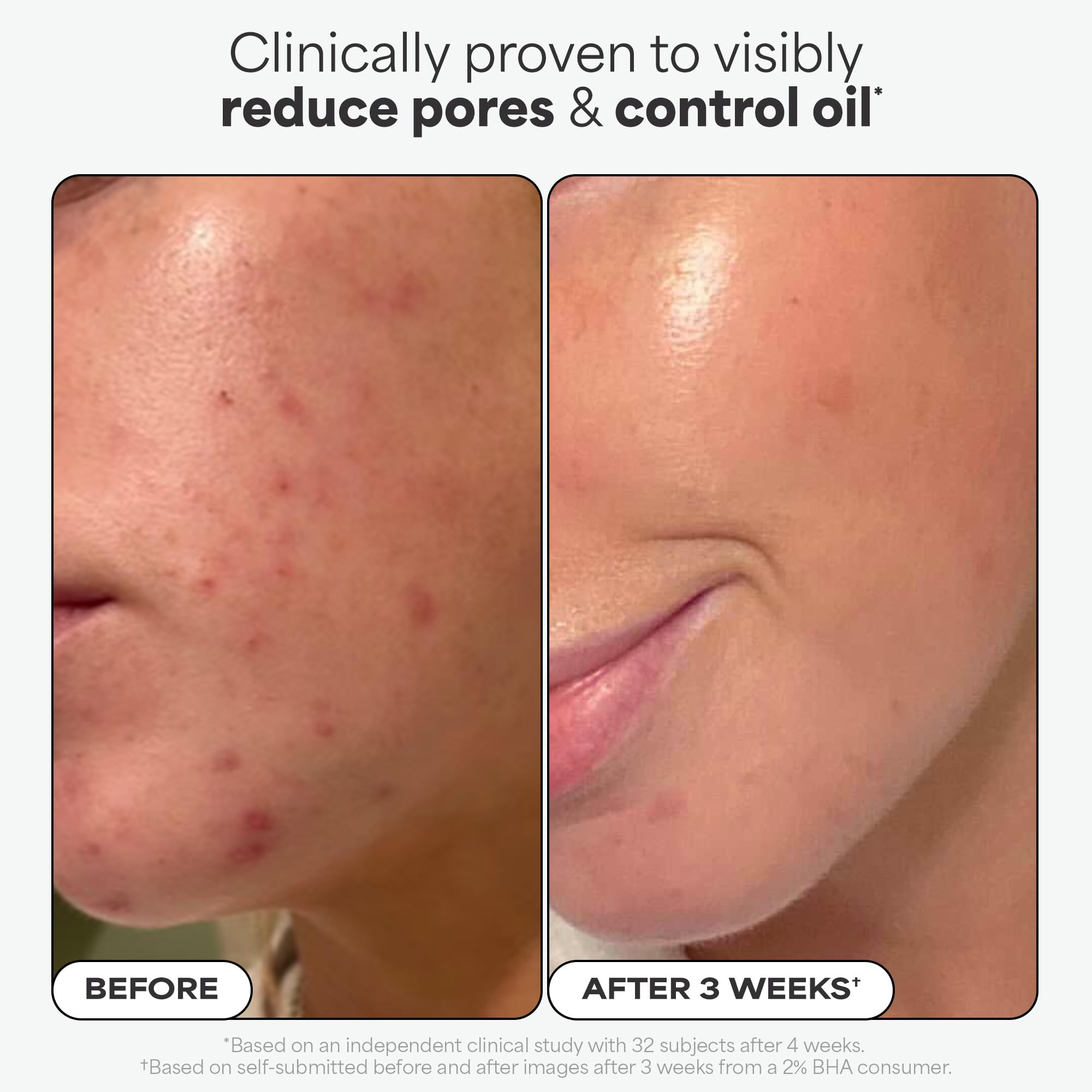 Paulas Choice - SKIN PERFECTING 2% BHA Liquid Salicylic Acid Exfoliant - Facial Exfoliant for Blackheads, Enlarged Pores, Wrinkles & Fine Lines, 4 oz Bottle - TrustMedUSA