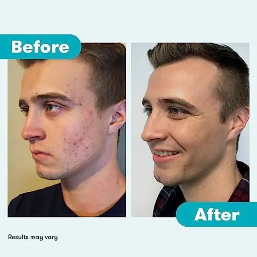 Proactiv 3 Step Acne Treatment - Benzoyl Peroxide Face Wash, Repairing Acne Spot - TrustMedUSA