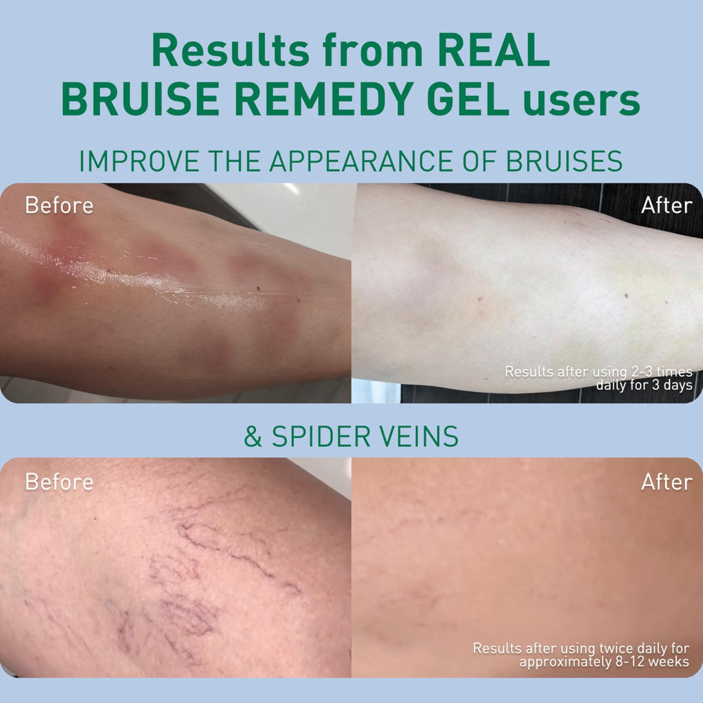 PROcure Arnica & MSM Bruise Remedy Gel – Paraben-Free, Unscented Arnica Montana Gel for Bruising, Spider Veins & Skin Discoloration – 2 Pack - TrustMedUSA