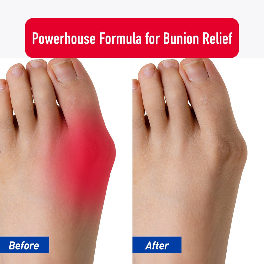 PROFOOT Bunion Relief Rub, White - TrustMedUSA