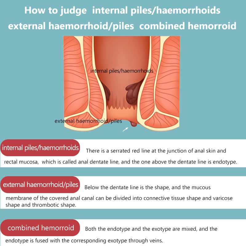 SERYNTH Hemorrhoid and Anal Fissure Ointment, Hemorrhoid Treatment, Fast Relief from Swelling, Pain, Itching, Burning (20g) - TrustMedUSA