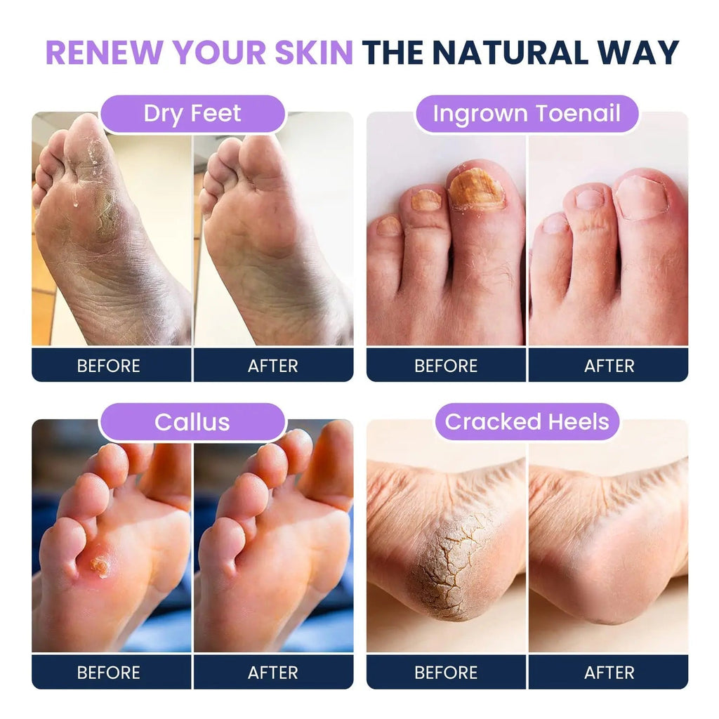 Soothing Lavender Foot Soak with Epsom Salt - Best Toenail Treatment, & Softens Calluses - TrustMedUSA
