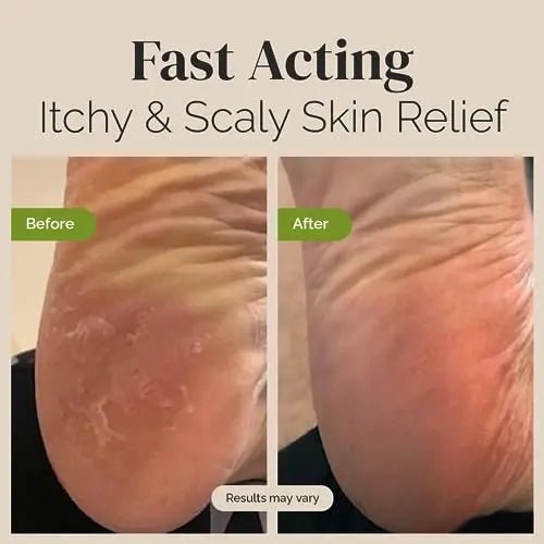 Tea Tree Oil Balm , Extra Strength, Pair Well with Jock Itch Cream, Spray, Athletes Foot - TrustMedUSA