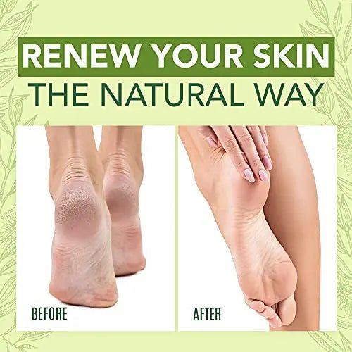 Tea Tree Oil Foot Cream For Dry Cracked Heels Repair - Natural Foot Cream For Dry Cracke - TrustMedUSA