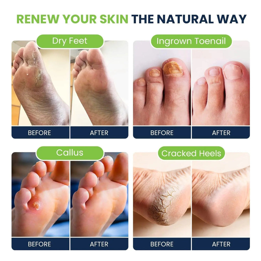 Tea Tree Oil Foot Soak with Epsom Salt - Best Toenail Fungus Treatment, Athletes - TrustMedUSA