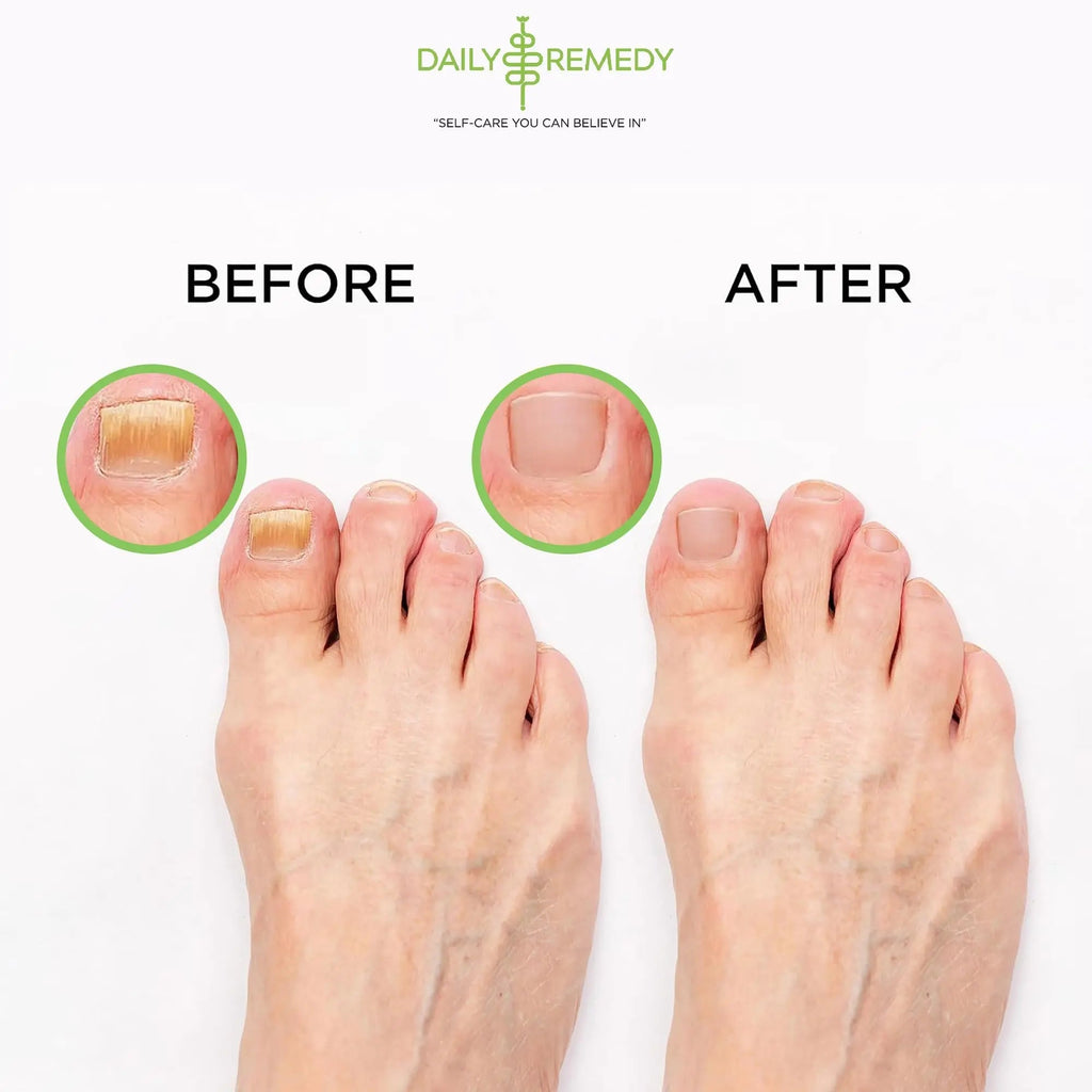 Tea Tree Oil Foot Soak with Epsom Salt - Made in USA - for Toenail Athletes Foot - TrustMedUSA