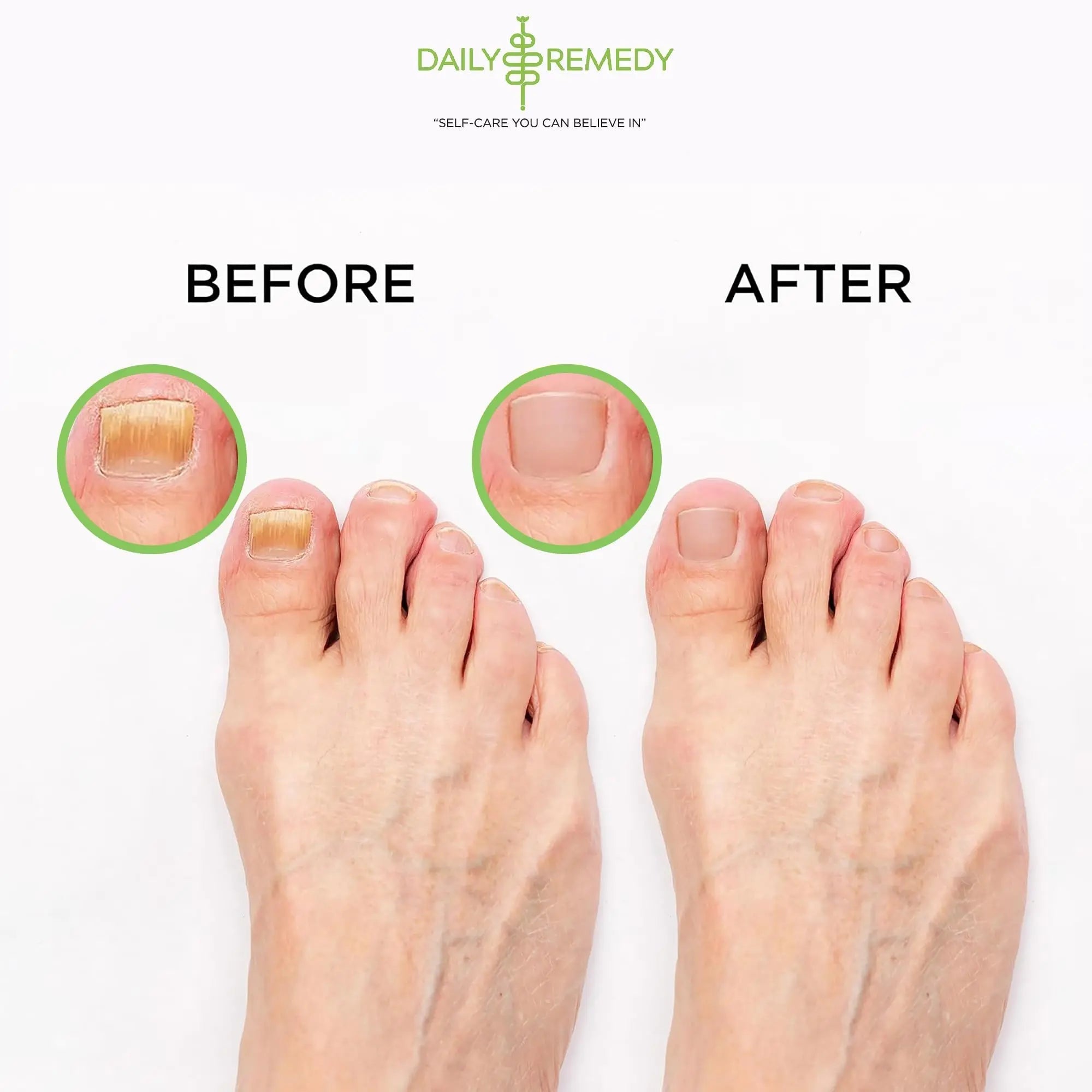 Tea Tree Oil Foot Soak with Epsom Salt - Made in USA - for Toenail Athletes Foot - TrustMedUSA
