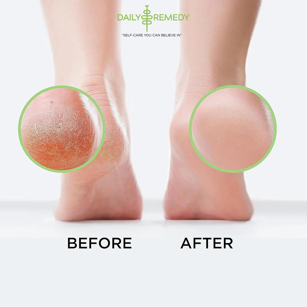 Tea Tree Oil Foot Soak with Epsom Salt - Made in USA - for Toenail Athletes Foot - TrustMedUSA