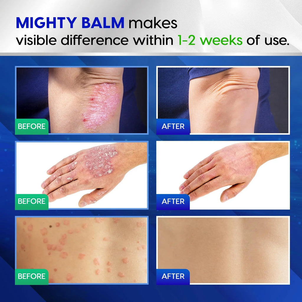 Tobcharm Antifungal Cream, Antifungal Cream for Skin, Ringworm Treatment for Humans - TrustMedUSA