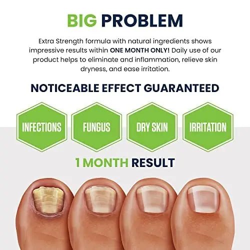 Toenail Fungus Treatment Extra Strength - Advance nail fungus treatment for fingernails - TrustMedUSA