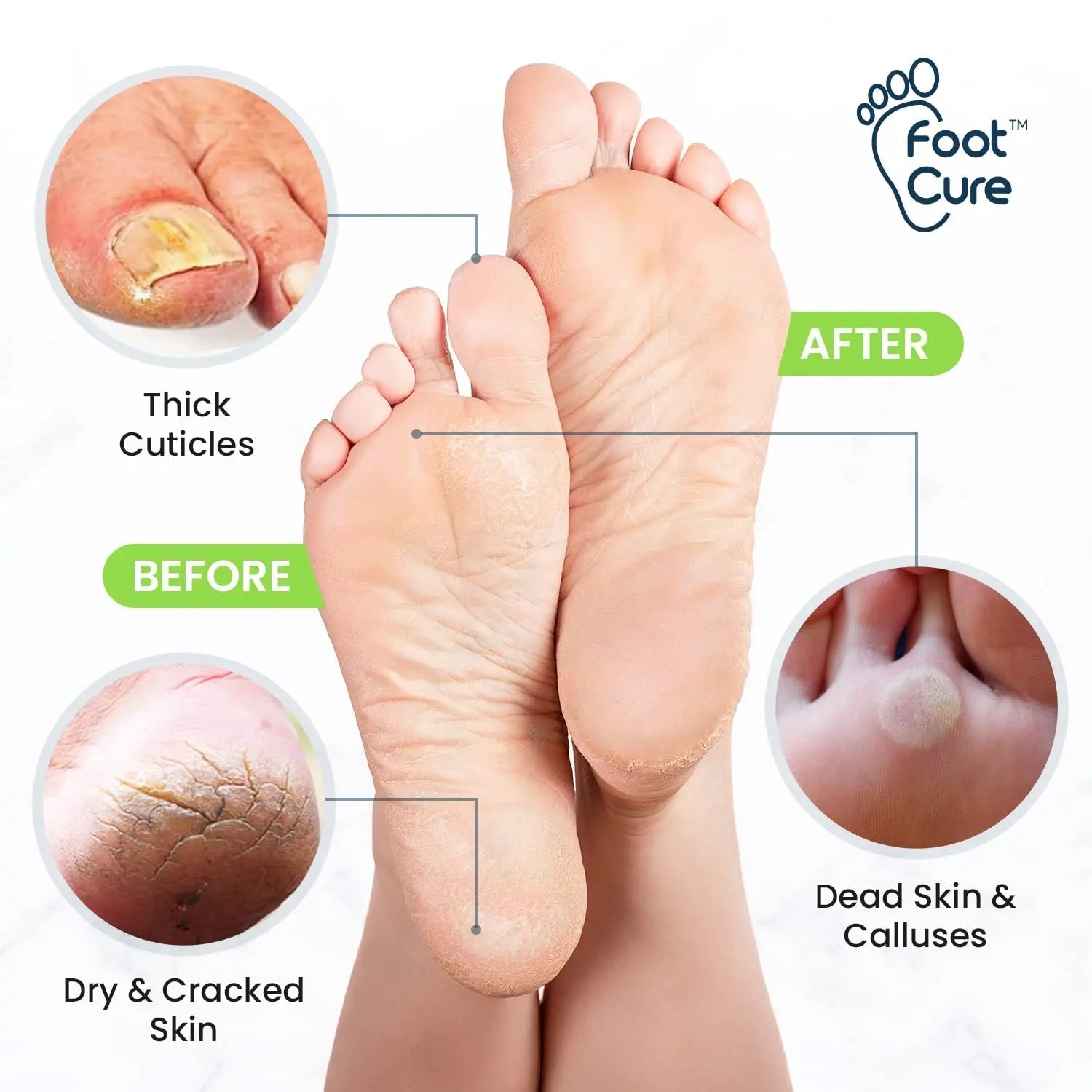 Toenail Fungus Treatment Extra Strength - Advance nail fungus treatment for fingernails - TrustMedUSA