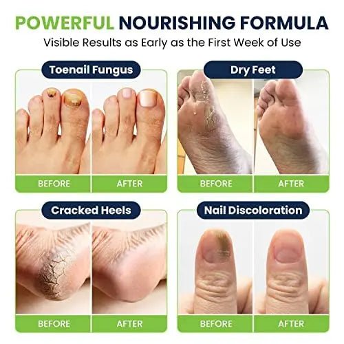 Toenail Fungus Treatment Extra Strength - Advance nail fungus treatment for fingernails - TrustMedUSA