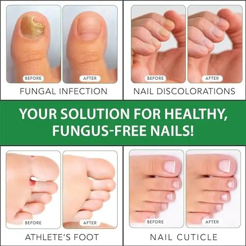 Viking Revolution Toenail Fungus Treatment Extra Strength with 1% Tolnaftate OTC - TrustMedUSA