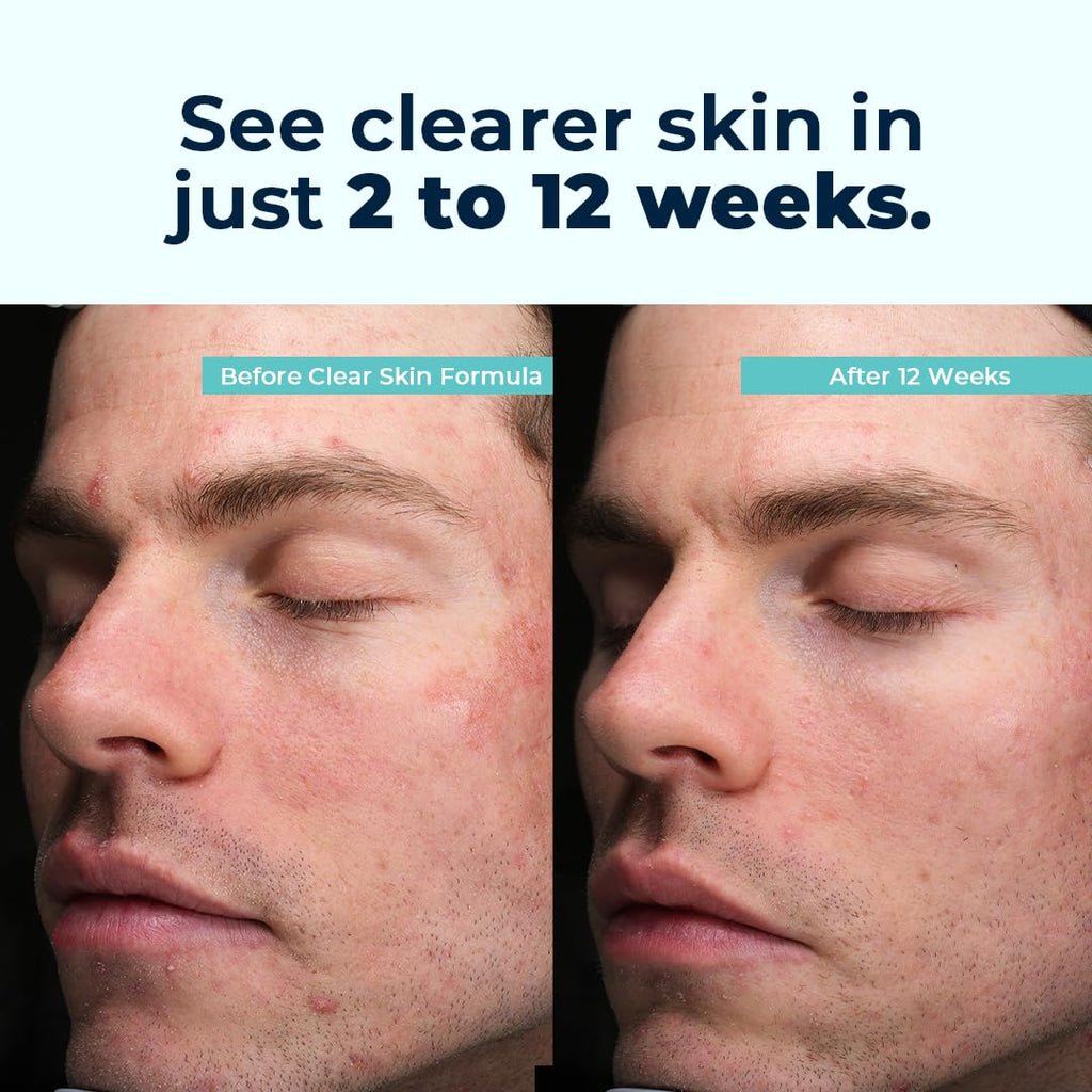 VitaMedica Clear Skin Vitamin Formula | Noncystic Acne Supplement for Skin Clearing | Breakout Treatment for Women and Men | Vitamins A, C, E, Selenium, Chromium, and Zinc for Skin Health | 2 Pack - TrustMedUSA