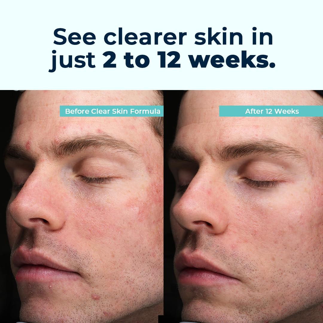 VitaMedica Clear Skin Vitamin Formula | Noncystic Acne Supplement for Skin Clearing | Breakout Treatment for Women and Men | Vitamins A, C, E, Selenium, Chromium, and Zinc for Skin Health | 2 Pack - TrustMedUSA